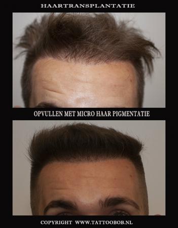 haartransplantatie opvullen met mhp 2018.jpg