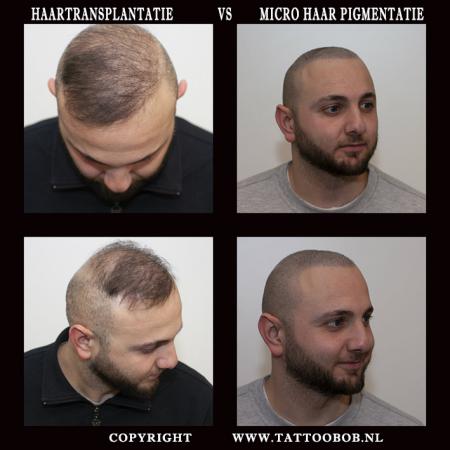 hairtransplant scalppigmentation 2019.jpg