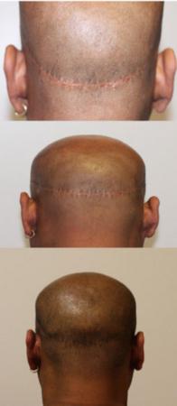 litteken haartransplantatie