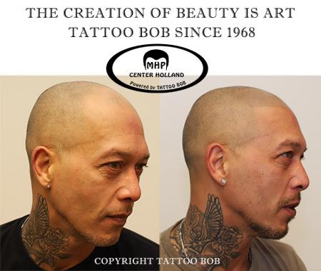 Micro Haar Pigmentatie is in de Verenigde Staten, ook wel bekend als Scalp Micropigmentation (SMP) of Scalp Pigmentation. In Nederland zult u veel het woord of de term "Stoppeltattoo"  horen . Tattoo Bob heeft dit begrip als eerste MHP-specialist in Neder