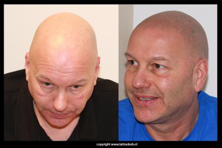 scalp-pigmentation-life-long-garanteed.jpg