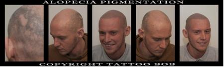 tattoo alopecia areata behandeling.jpg