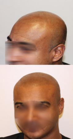 Scalp pigmentation tattoo bob