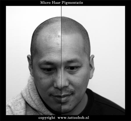 haarpigmentatie (MHP)