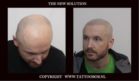 scalp pigmentation