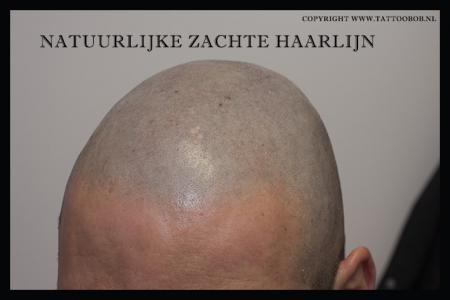 zachte haarlijn met micro haar pigmentatie