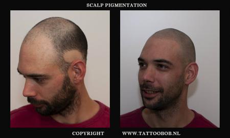 Scalp tattoo is ook bekend als micro haar pigmentatie. Tattoo Bob noemt het Stoppeltattoo