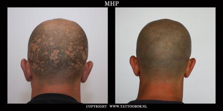 micro haar pigmentatie is de beste oplossing bij alopecia