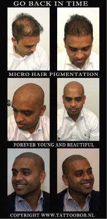 Natural look with scalp micro pigmentation