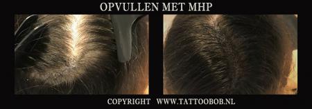 opvulling bij lang dun haar, micro haar pigmentatie, mhp