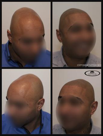 Afro stoppel of pigmentatie voor de zwarte huid