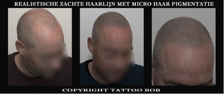 Een natuurlijke haarlijn is mogelijk met Micro haar pigmentatie ook wel bekend als scalp pigmentatie. Tattoo Bob noemt het Stoppeltattoo