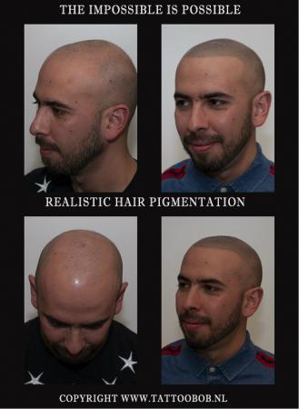 Veel mensen gaan naar Turkije voor een haartransplantatie. Een hoop komen terug om toch te kiezen voor micro haar pigmentatie . Micro haar pigmentatie is de nieuwe oplossing !