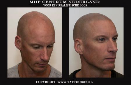 Micro haar pigmentatie is de wereldwijde sensatie in Nederland ook bekend als stoppeltattoo