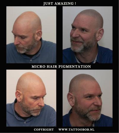 Stoppeltattoo ofwel micro haar pigmentatie is momenteel de enige echte oplossing tegen kaalheid