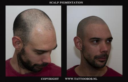 scalp pigmentation is de oplossing voor kaalheid . In Nederland bekend als stoppel tattoo