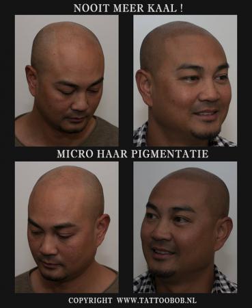 micro haar pigmentatie is ook voor de getinte huid zeer geschikt. Met de MHP daar leef je mee !