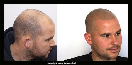 microhaarpigmentatie bij kaalheid