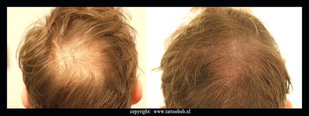 opvullen haar door microhaarpigmentatie