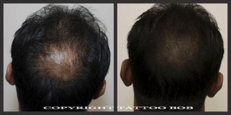 kruin opvullen d.m.v. microhaarpigmentatie