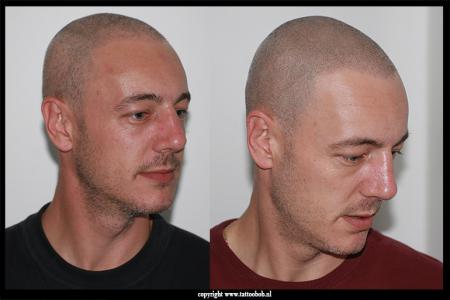 scalp pigmentatie is de oplossing bij dun of kaal haar