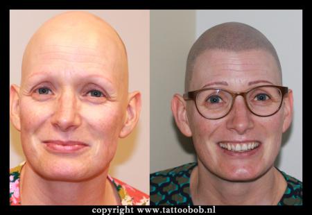 alopecia-bij-vrouwen-2---9-9-2023.jpg