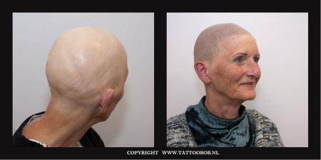 alopecia bij vrouwen wordt opgelost door mhp