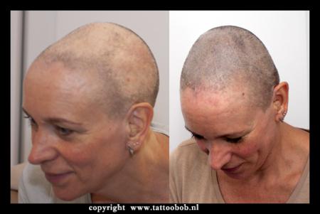 microhaarpigmentatie bij alopecia