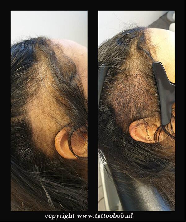 Alopecia behandeling