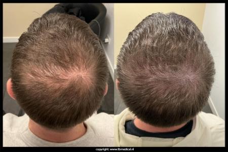 lang-haar-MHP-behandeling-20.jpg