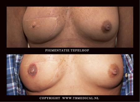 tb medical tepel hof tattoo reconstructie.jpg