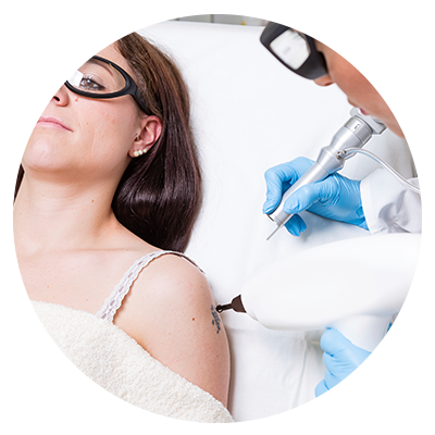 Spijt van je Tattoo ?