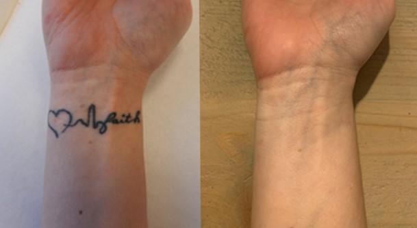 tattoo verwijderen; before and after. tattoo weglaseren