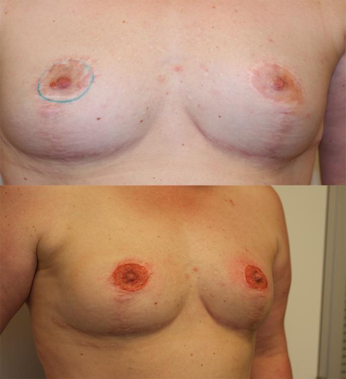 Medische tatoeages