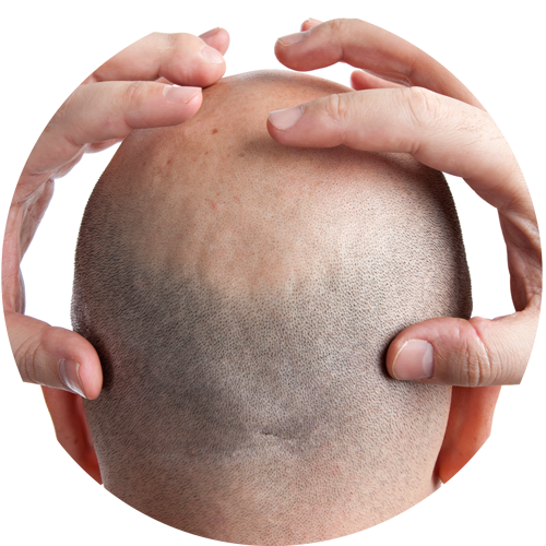 Micro haar pigmentatie ervaringen