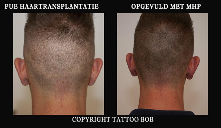 scalp pigmentatie