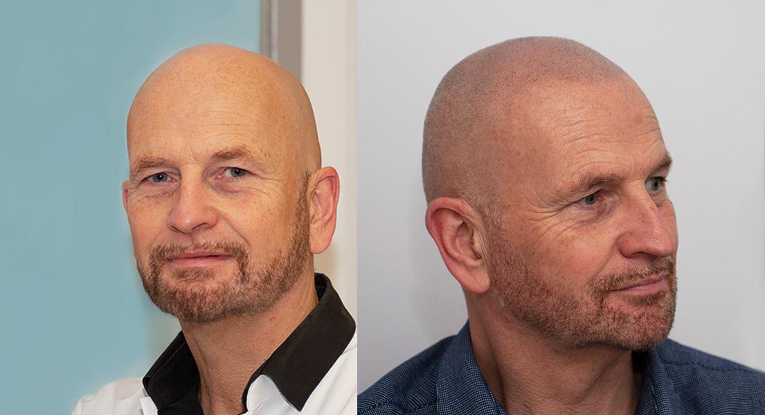 mhp / micro haar pigmentatie - Mike 