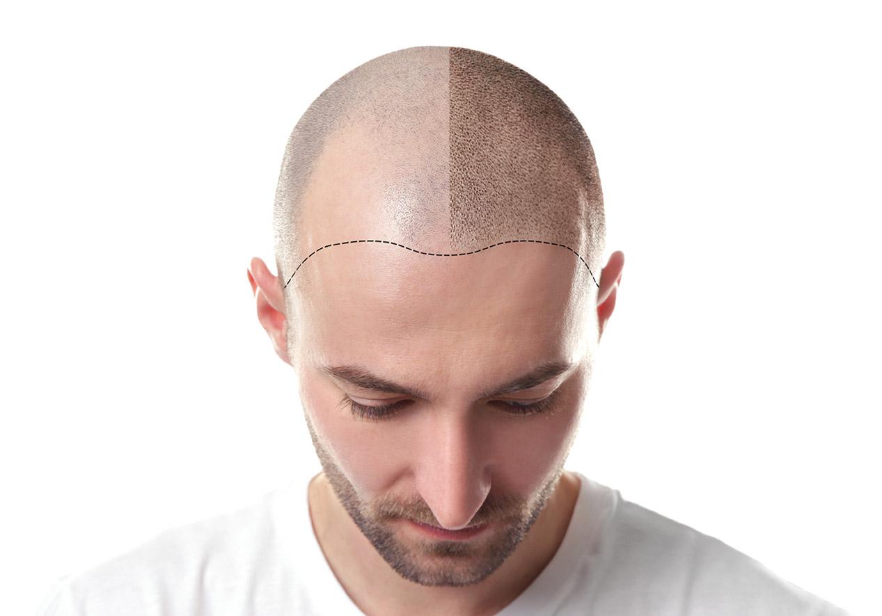 mhp micro haar pigmentatie man