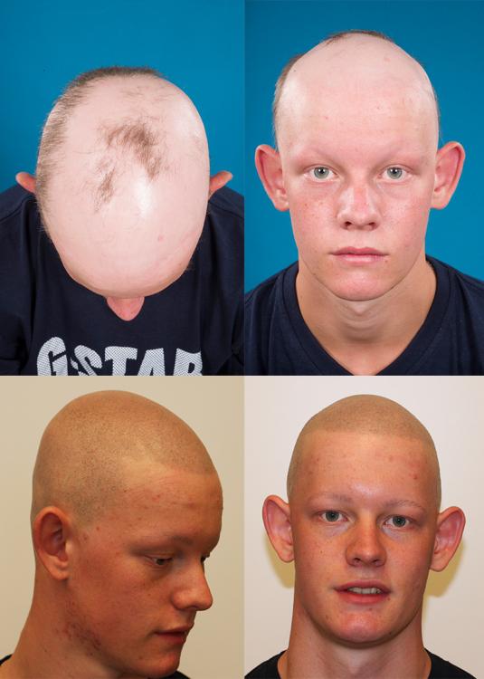 Alopecia: ongekende resultaten bij Tattoo Bob