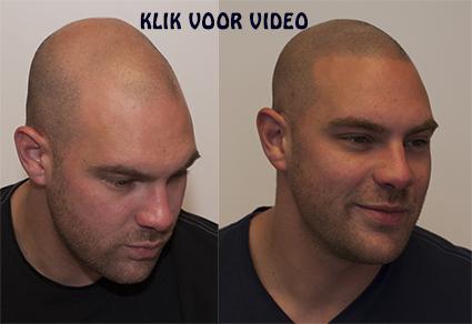 De oplossing tegen kaalheid !